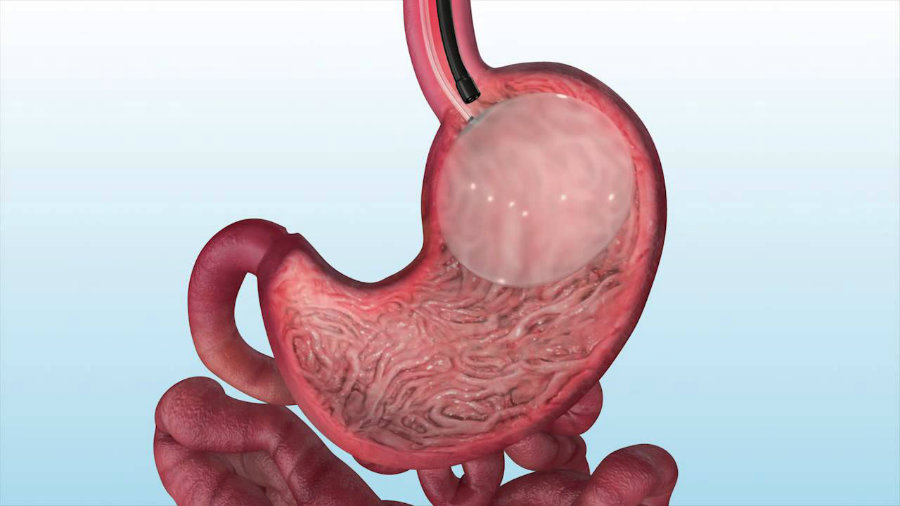The intragastric balloon is placed inside the human's stomach to create a sensation of fullness. Image credit Hedden Plastic Surgery Youtube Channel
