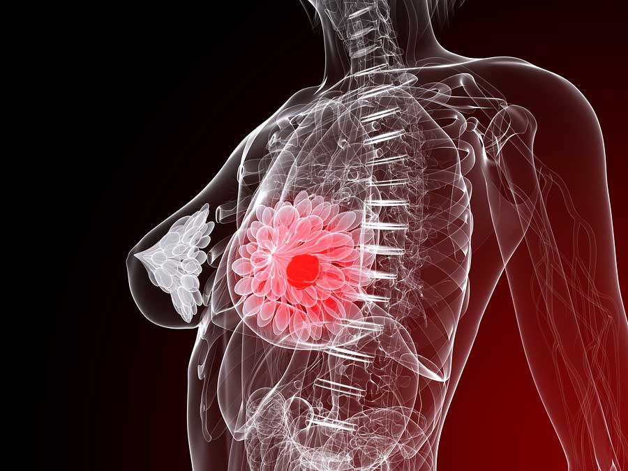 3d rendered illustration of a female anatomy with tumor in breast. 
