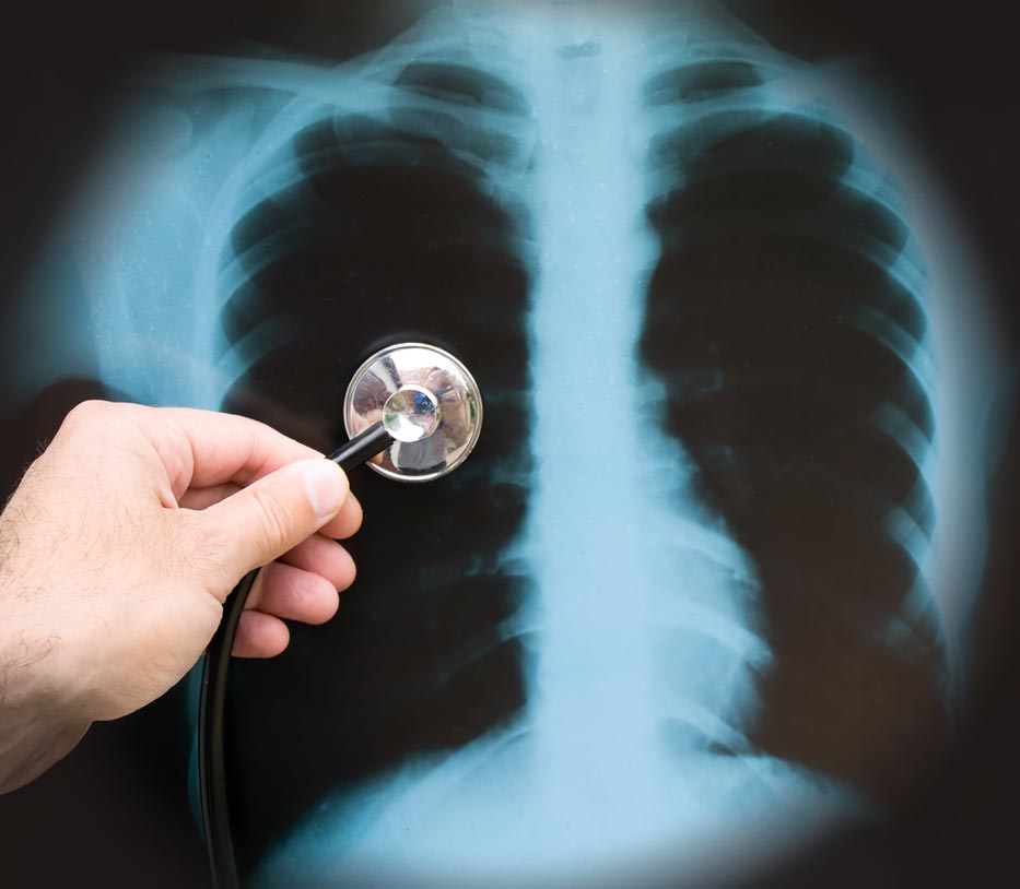 pneumonia-xray