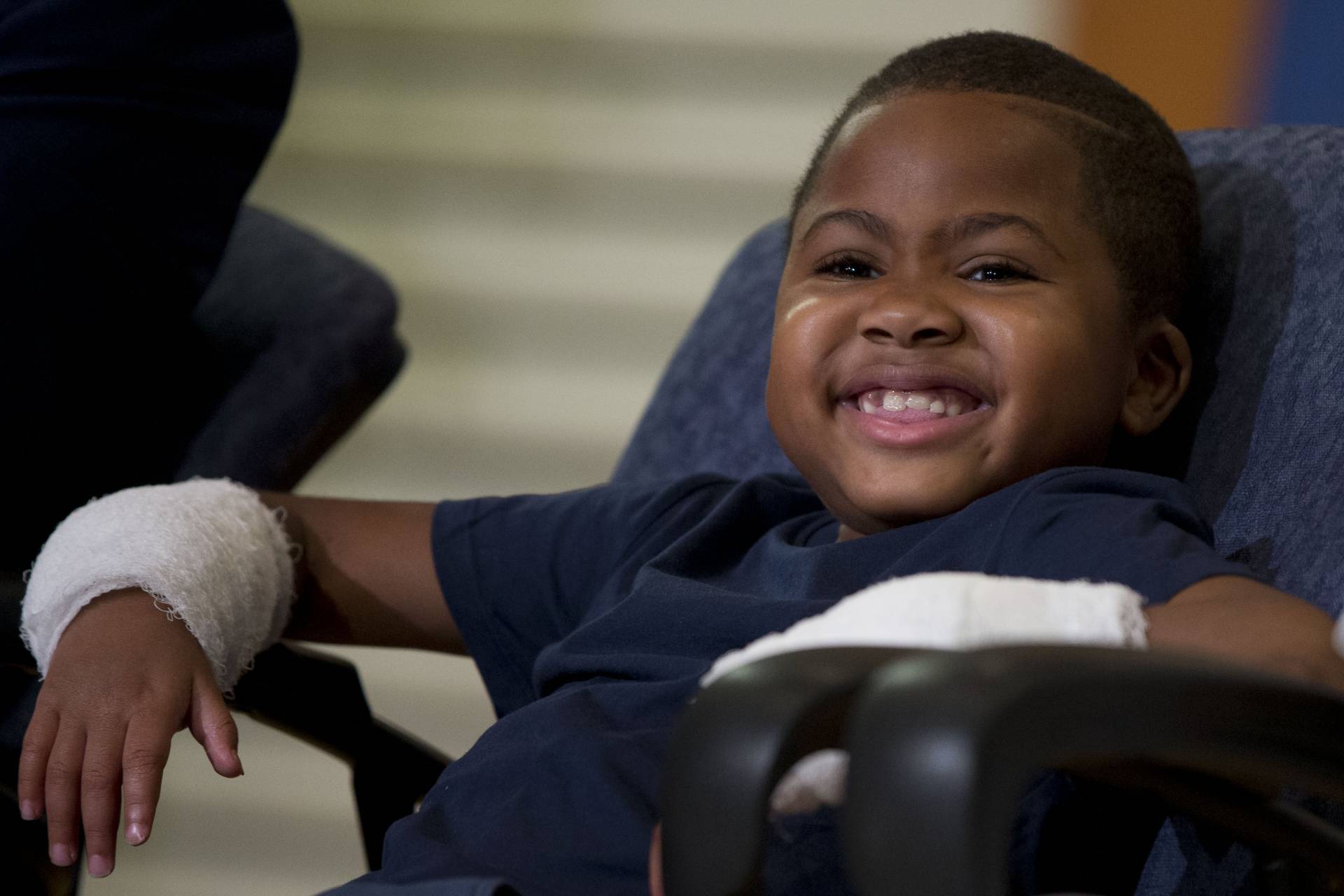 Double Hand Transplant-Child