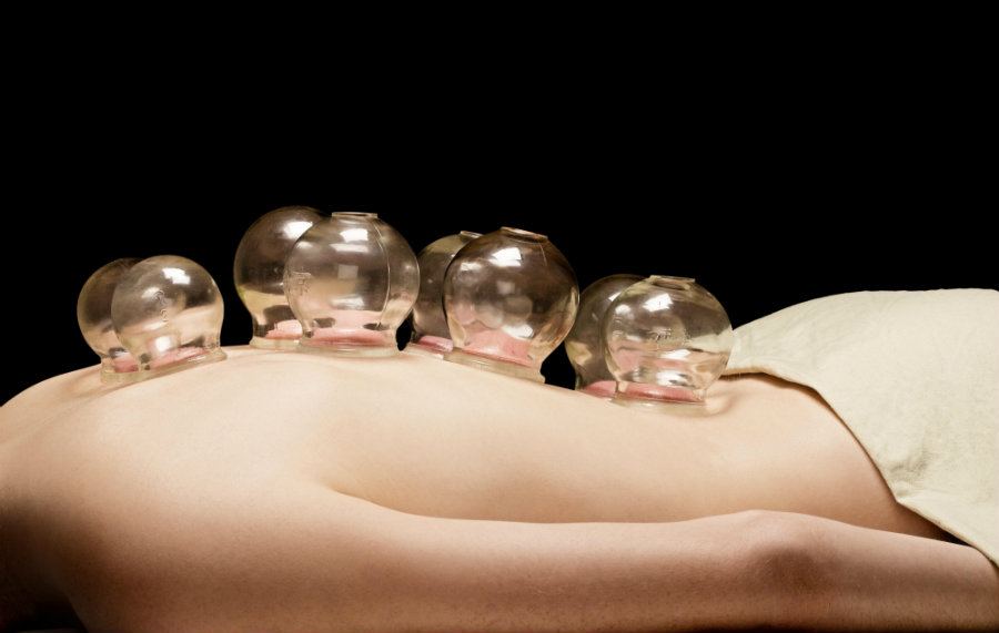 Cupping is an alternative form of pain relief through which a flexible cup is placed on the skin on sore muscles, and sucks the skin up into the cup. Photo credit: Wild Woods Yoga & Wellness