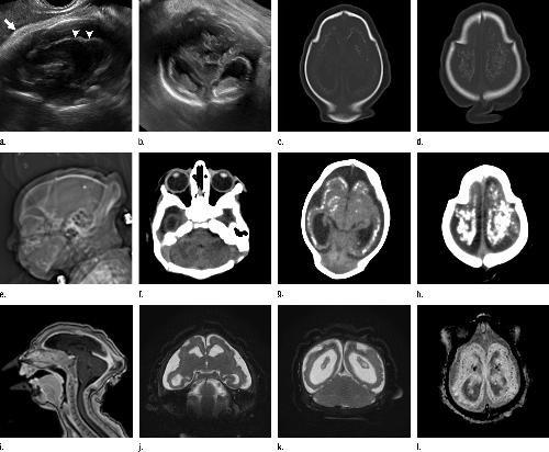 Brain scans of Zika-infected baby with microcephaly