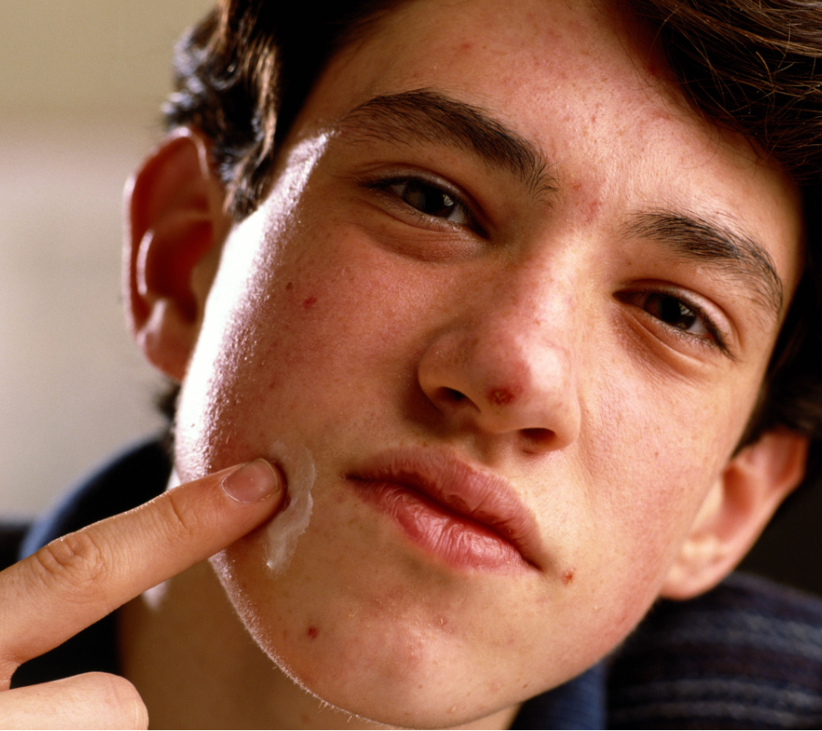 Boy with acne