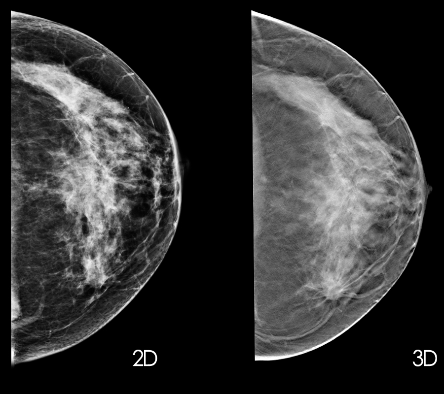 New guidelines: Mammograms should start at 50