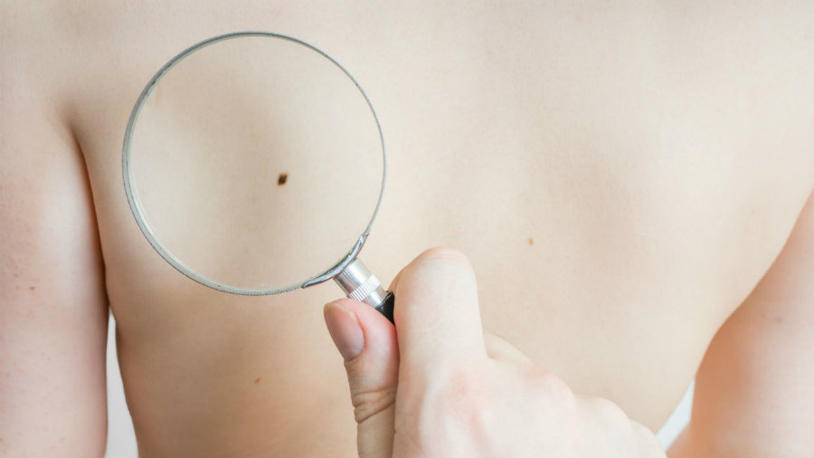 Melanoma cases have been dropping in the northern region of the United States. Photo credit: Vchalup / Fotolia / Empowher