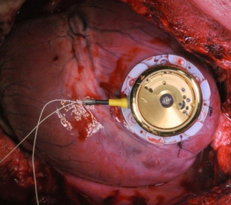 Batteryless cardiac pacemaker