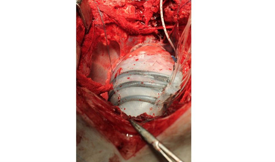 The sleeve is made of thin silicone and is equipped with pneumatic actuators located around the organ. Photo credit: Ellen Roche / Harvard University / Live Science