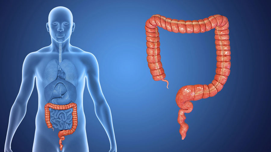 colorectal-cancer