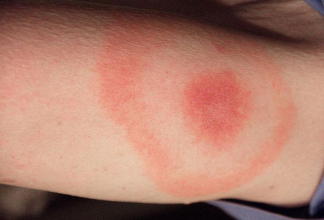 Lyme Disease