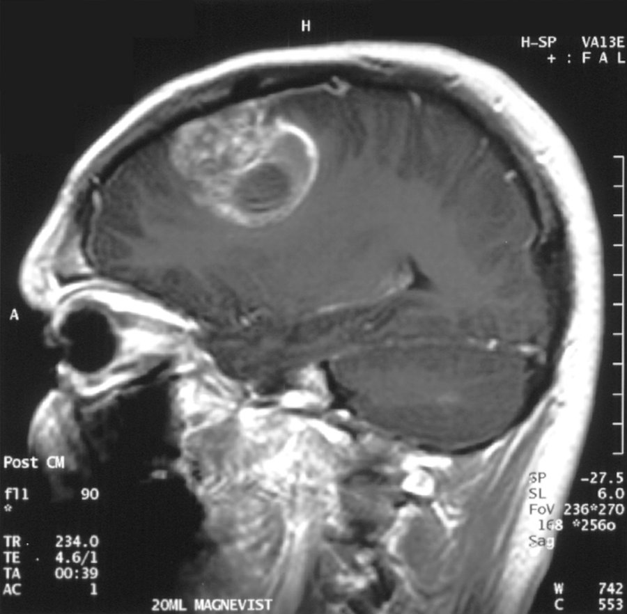 Gglioblastoma. Image credit: Neurooncologia.com