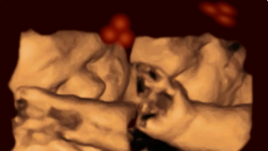 Ultrasound of fetus