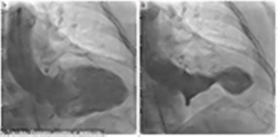 Takotsubo cardiomyopathy, Broken Heart syndrome