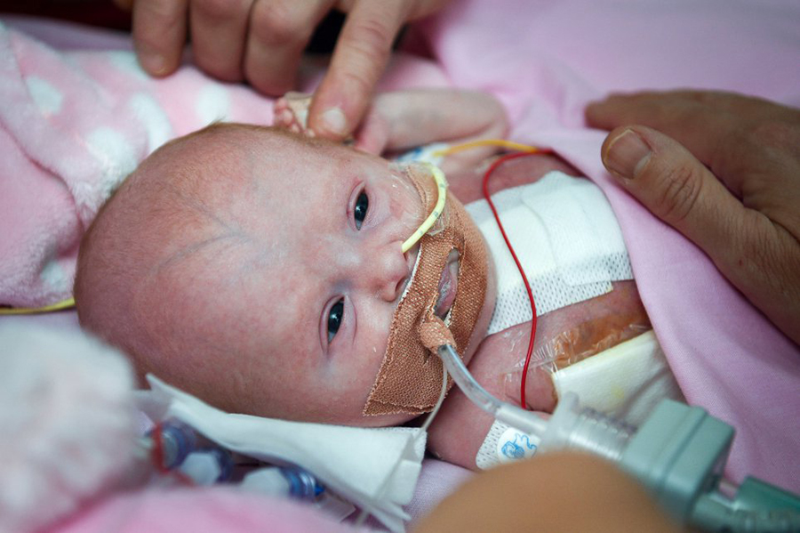 Baby born with heart outside the body, United Kingdom, Ectiopia cordis,