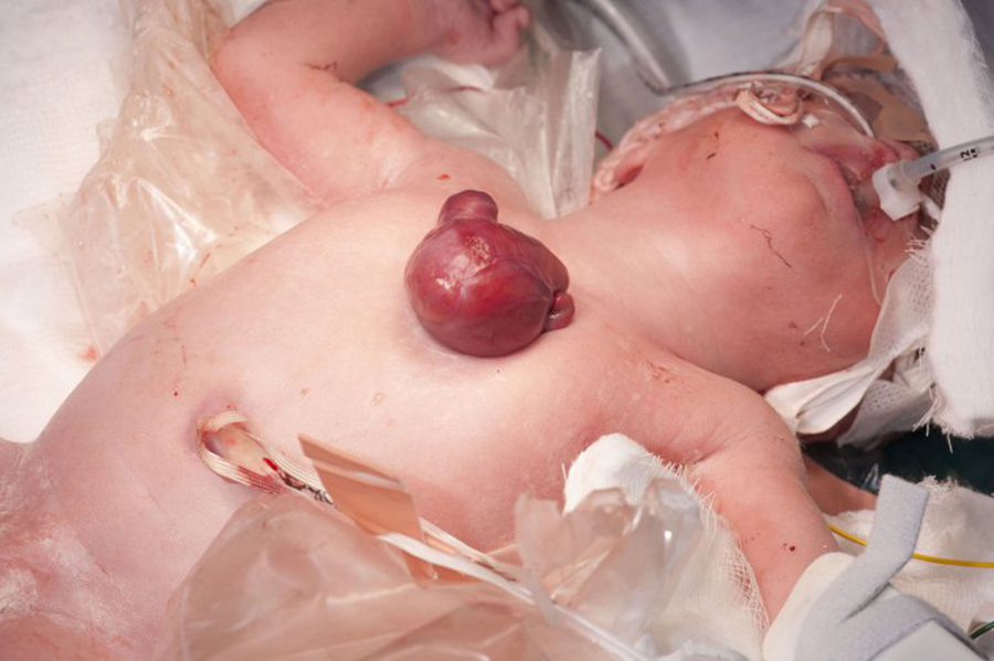 Baby born with heart outside the body, United Kingdom, Ectiopia cordis,
