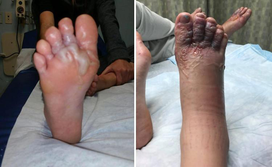 Canadian couple gets hookworms after walking barefoot in a Punta Cana beach, Dominican Republic, Hookworms in the beach, Couple gets hookworms in Punta Cana beach
