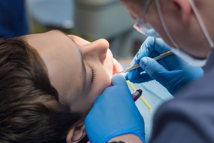Dental Sealants: Benefits and Risks