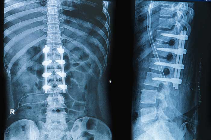 Spinal Implants & Fusion Methods